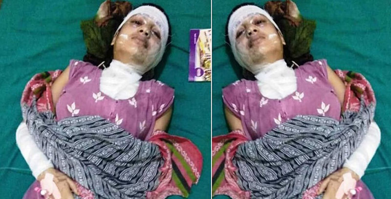 तेजाब प्रकरण : थप उपचारका लागि काठमाडौँ सिफारिस