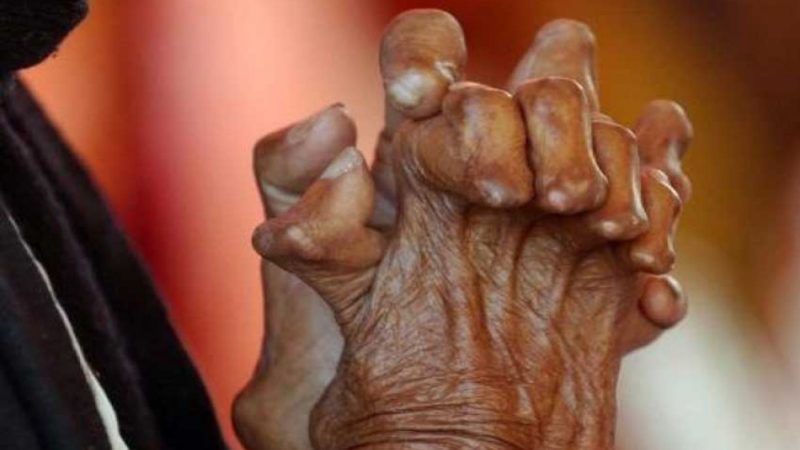 ६७औँ कुष्ठरोग दिवस : अझै पनि खुल्न सक्दैनन् कुष्ठरोगी